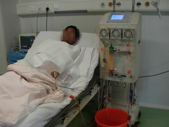 腹水濃縮回輸術治療頑固性腹水