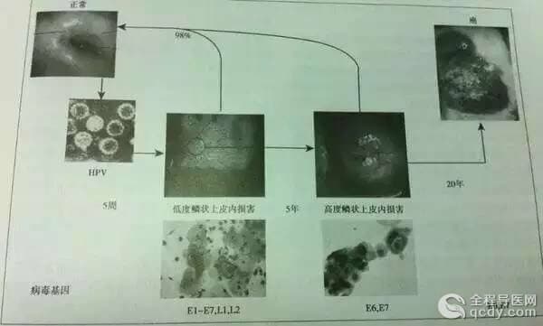 等了10年!宮頸癌疫苗終于要在內地上市,就在明年年初!轉給身邊所有的女性!