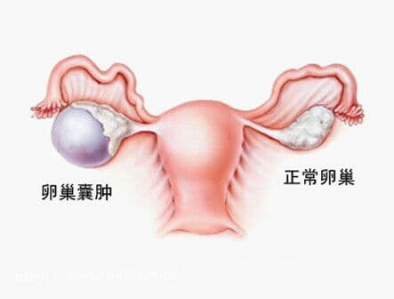 卵巢囊腫可保留卵巢功能微創治療 術后需定時復查以防復發