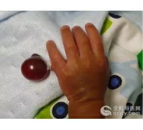 兒童小指尺側肉贅縫扎不徹底會引發感染 3個月大手術切除