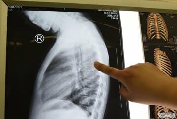 繡花針扎入7歲女童腋下1年多針體移位 徐州仁慈醫院手術成功取出