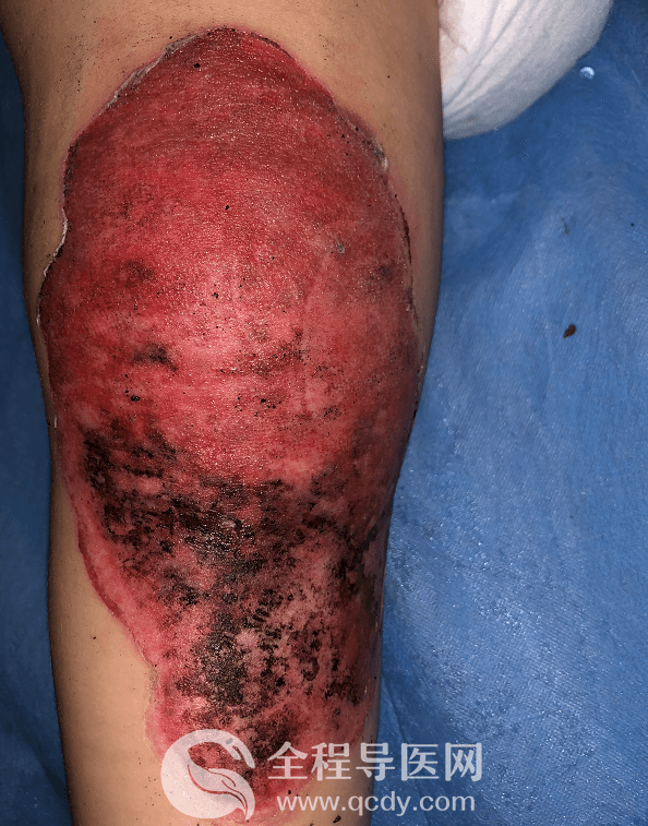 2歲男娃腿燙傷自敷草藥治療致高熱驚厥-兒童醫院燒傷科醫生談：燙傷應如何處理？