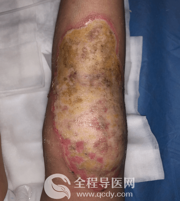 2歲男娃腿燙傷自敷草藥治療致高熱驚厥-兒童醫院燒傷科醫生談：燙傷應如何處理？