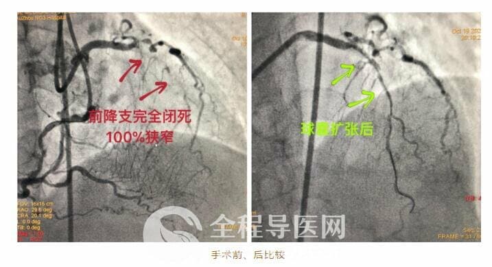 徐州市三院心臟團隊于長城心臟病學大會CTO論壇直播超高難度冠心病介入手術