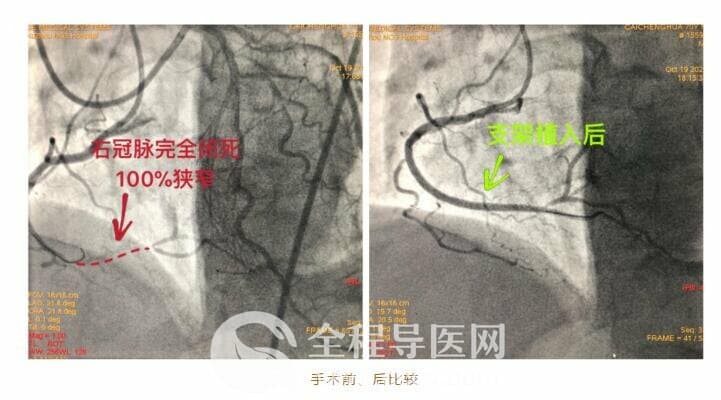 徐州市三院心臟團隊于長城心臟病學大會CTO論壇直播超高難度冠心病介入手術