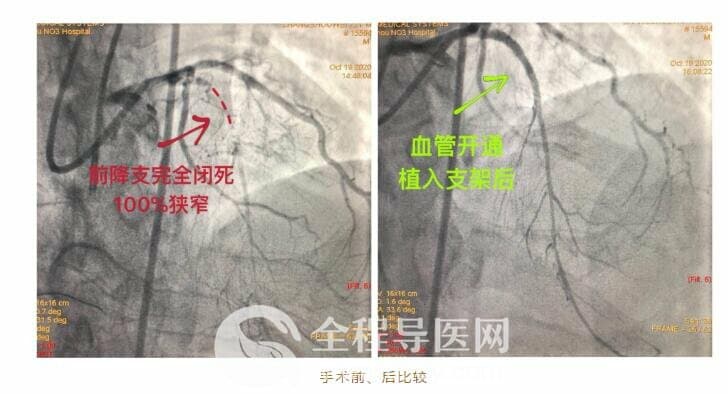 徐州市三院心臟團隊于長城心臟病學大會CTO論壇直播超高難度冠心病介入手術