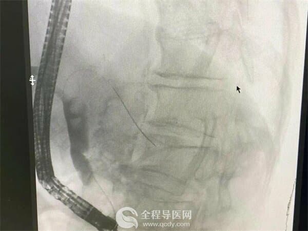 九旬老人腹痛發熱難忍 徐州市一院運用新術式成功取石