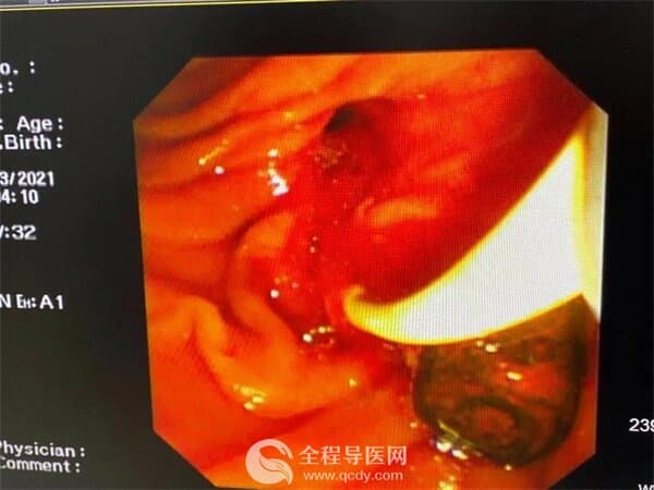 九旬老人腹痛發熱難忍 徐州市一院運用新術式成功取石