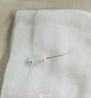牙疼根管治療牙髓針卻掉入肺部 徐州市腫瘤醫院氣管鏡取出兇險異物